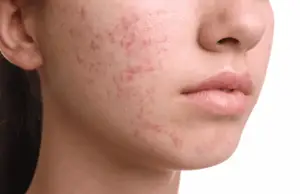 Hormonal Acne - featured image