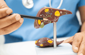 Fatty liver Singapore featured image